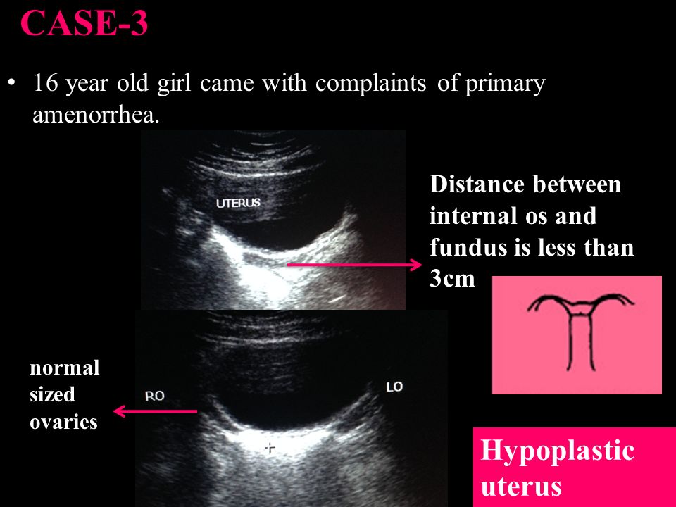 CASE-3 Hypoplastic uterus