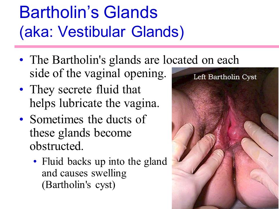 Vagina tumor