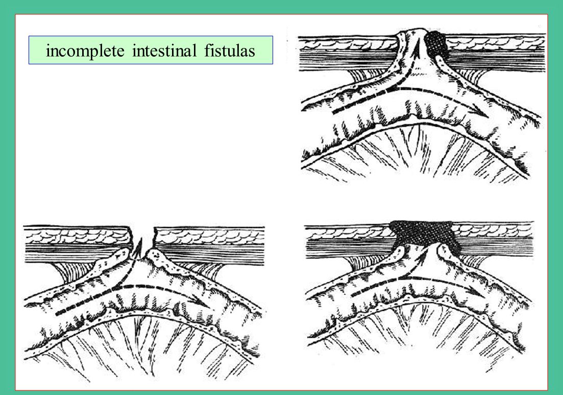 Кишечный свищ. Губовидные и трубчатые свищи. Несформированный свищ.