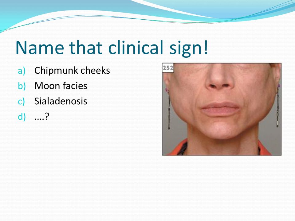 Bulimia Chipmunk Face