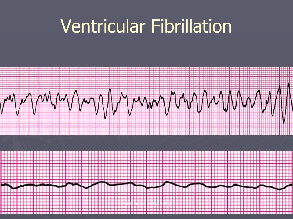 Ventricular Fibrillation.