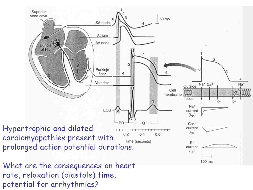 Hypertrophic and dilated cardiomyopathies present with prolonged action potential durations.