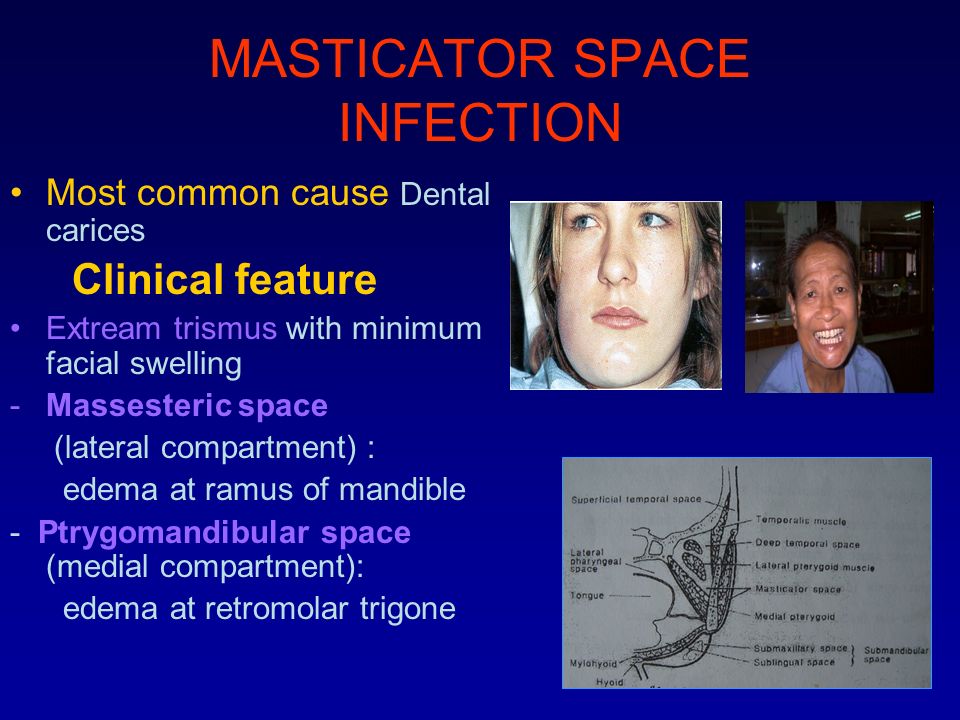 Deep Neck Infection Ppt Video Online Download