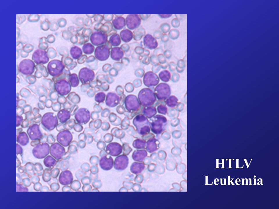 HTLV Leukemia