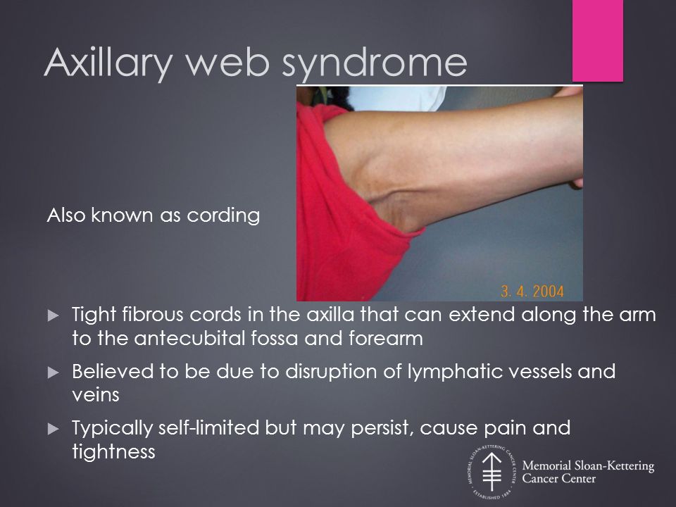 Post Mastectomy Syndrome Identification Ppt Download