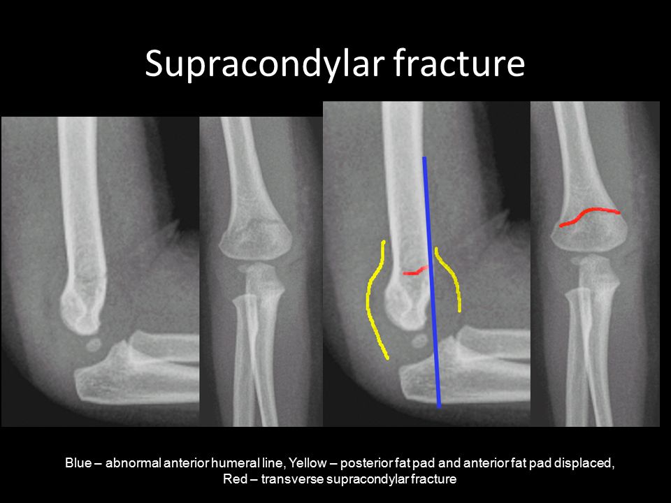 Supracondylar fracture.