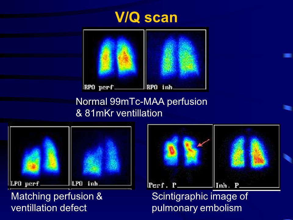 Ventilation – perfusion (V/Q) scintigraphy - ppt video online download