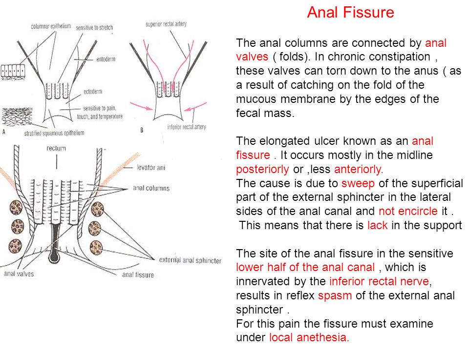 Symptomatic Chronic Posterior Anal Fissure Anal