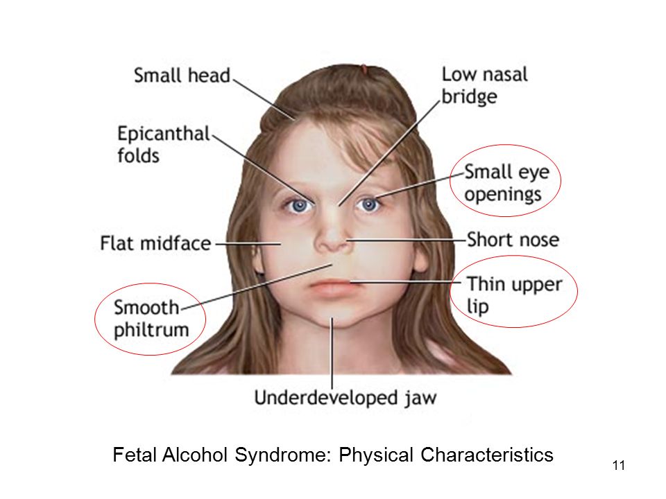 Fetal Alcohol Syndrome: Physical Characteristics