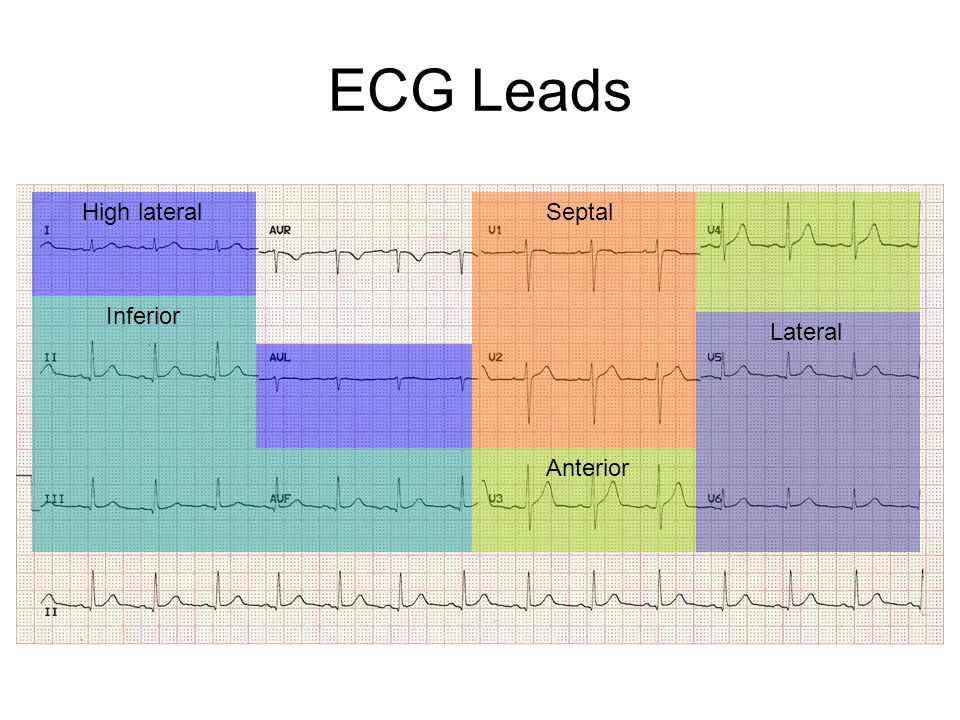 ECG Leads. 