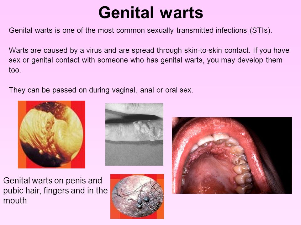 Genital warts Genital warts is one of the most common sexually transmitted ...