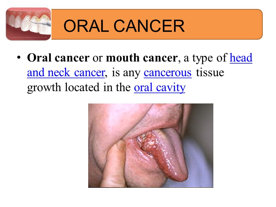 oral-cavity-cancer-pictures