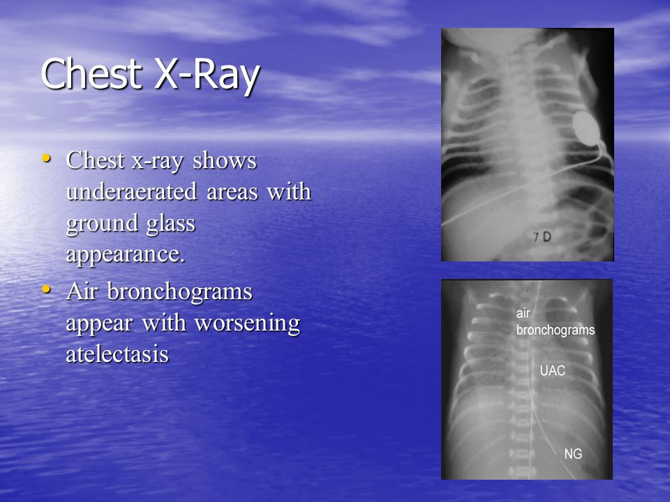 Respiratory Distress Syndrome Rds Ppt Video Online Download