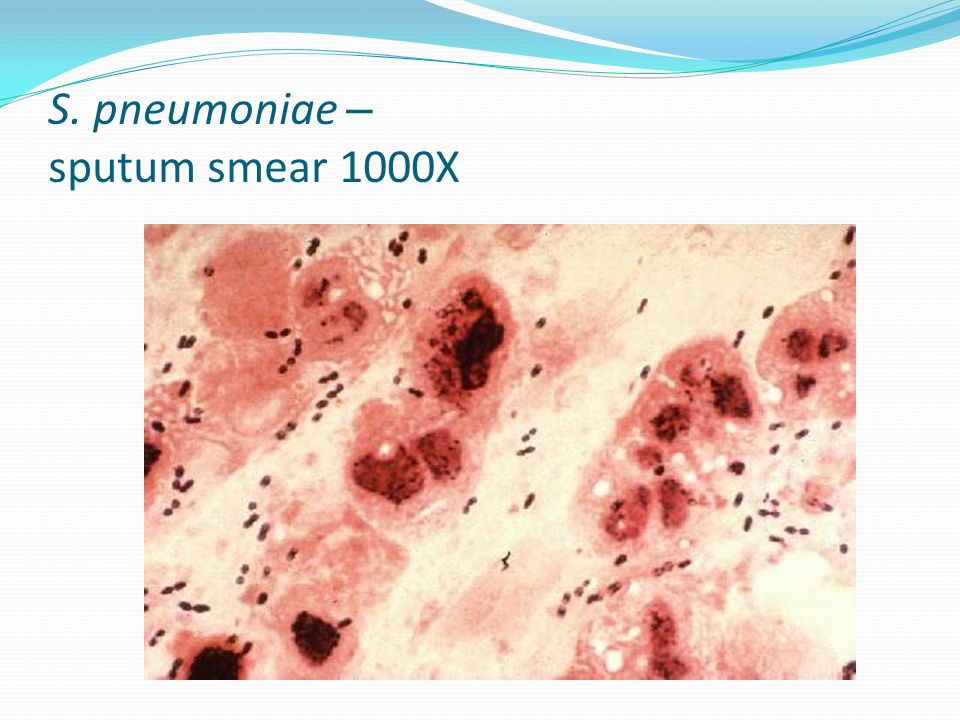 S. pneumoniae – sputum smear 1000X