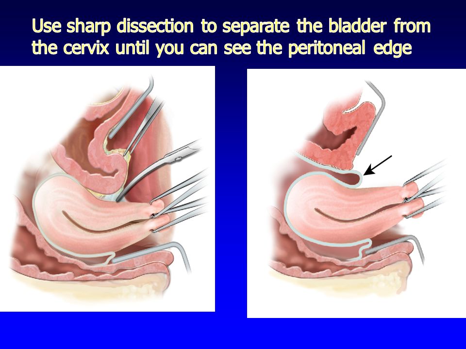 Use sharp dissection to separate the bladder from the cervix until you can ...