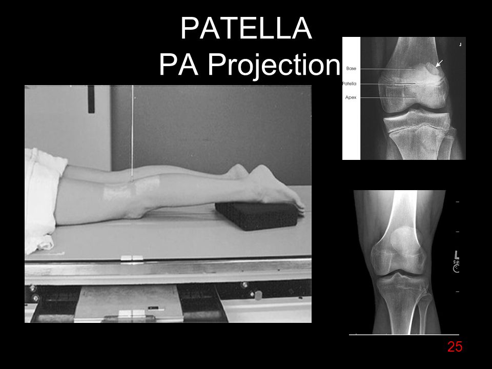 PATELLA PA Projection.