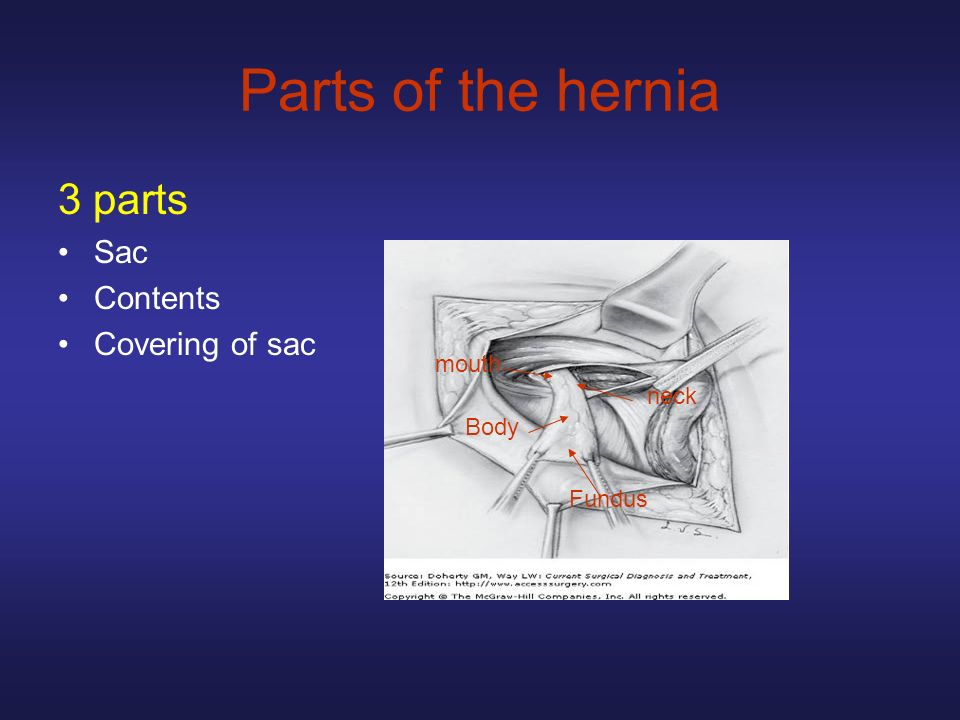 Abdominal wall hernias - ppt video online download