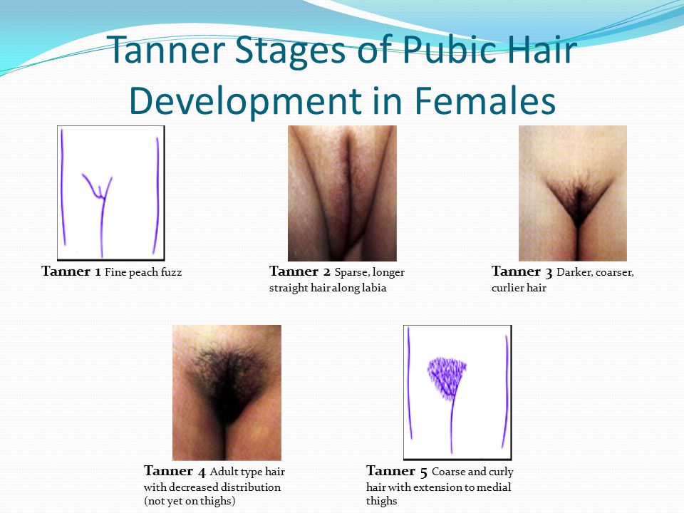 Tanner Stages of Pubic Hair Development in Females.