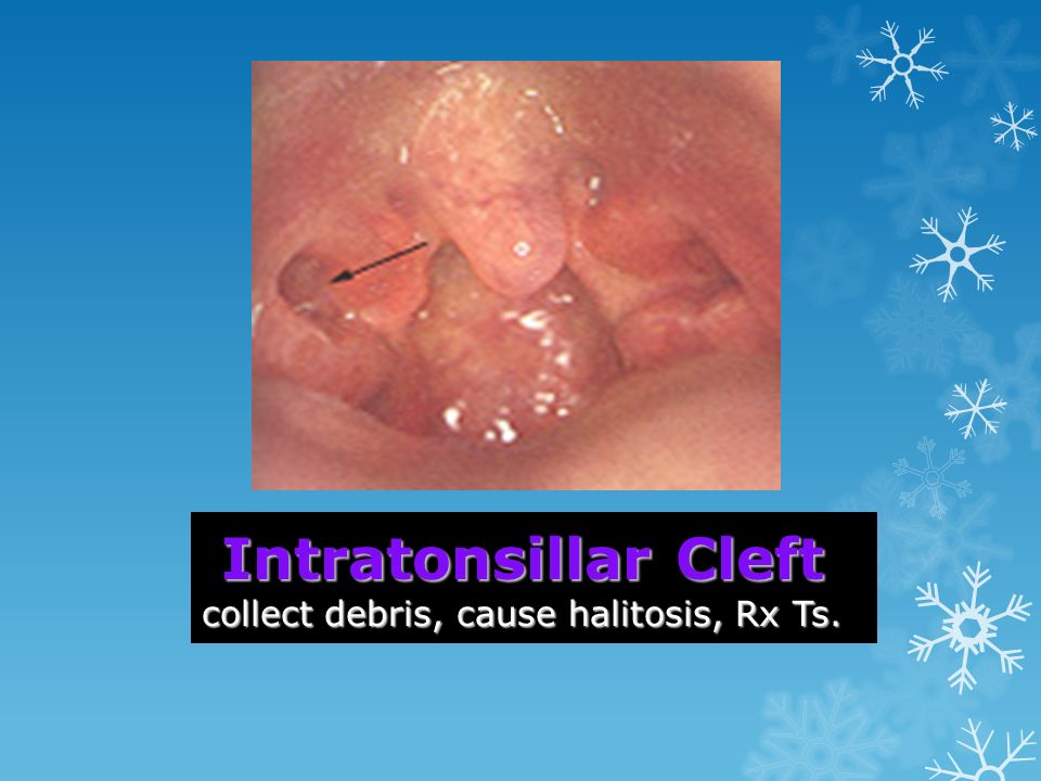 Intratonsillar Cleft collect debris, cause halitosis, Rx Ts.
