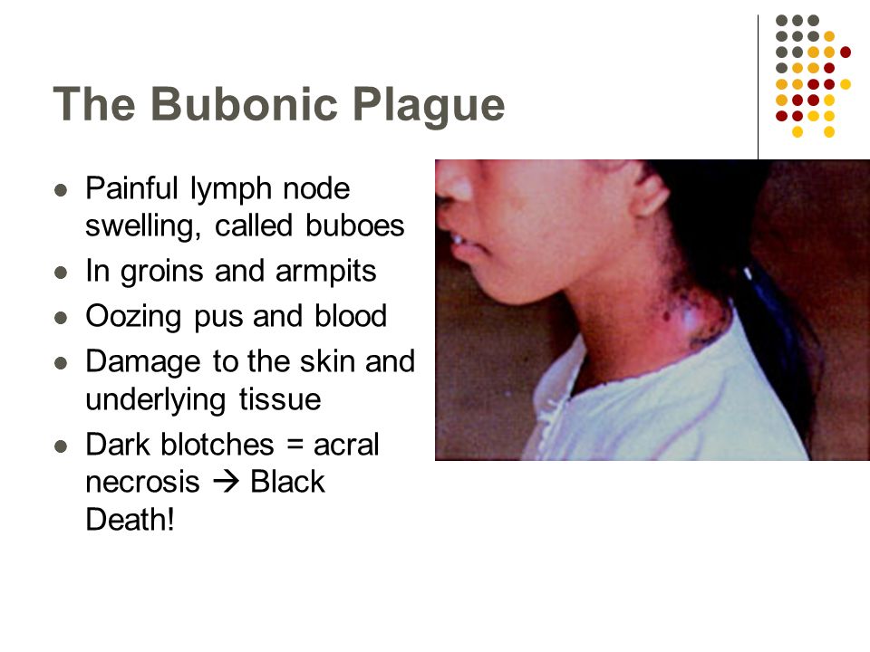 The Bubonic Plague Painful lymph node swelling, called buboes