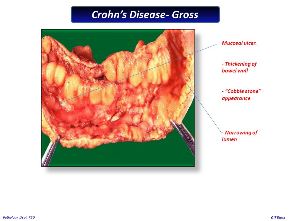 Crohn's And Colitis