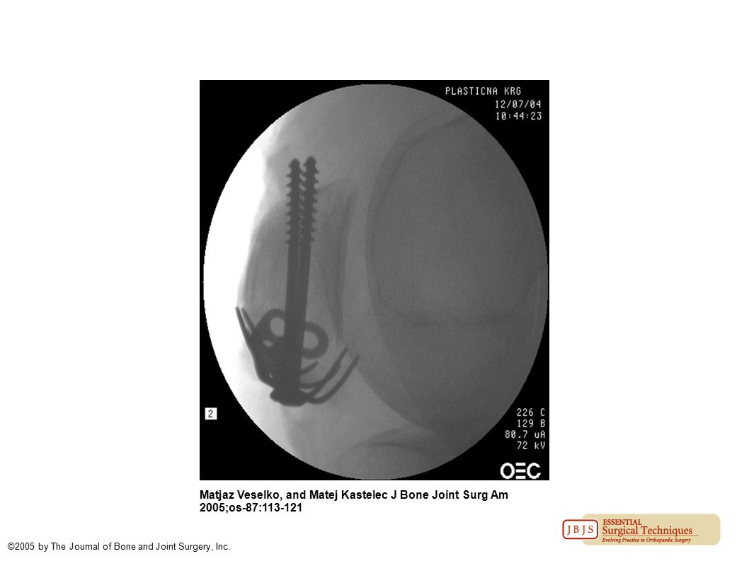 Matjaz Veselko, and Matej Kastelec J Bone Joint Surg Am 2005;os-87: