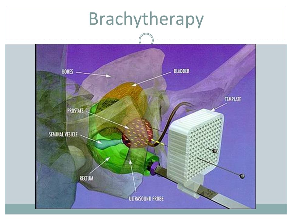 Онкология простаты лучевая. Брахитерапия лучевая терапия. Контактная лучевая терапия. Аппликаторы для брахитерапии.