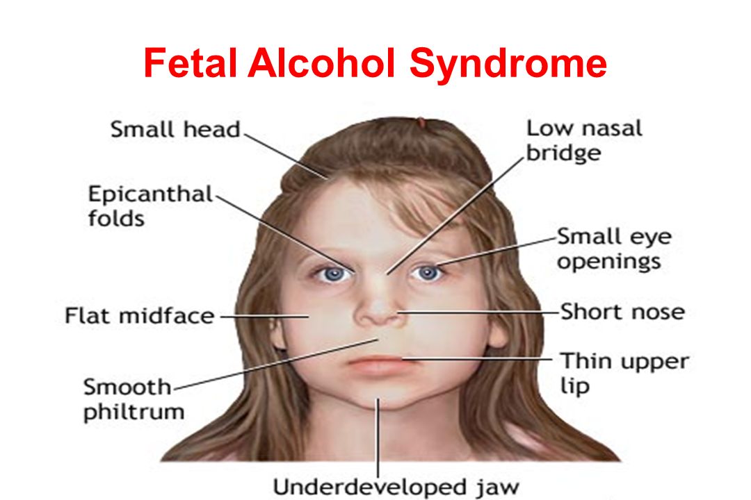 Алкогольные дети признаки. ФАС фетальный алкогольный синдром. Алкогольный фетальный синдром мкб-10. Внутриутробный алкогольный синдром. Фетальный алкогольный синдром у детей.
