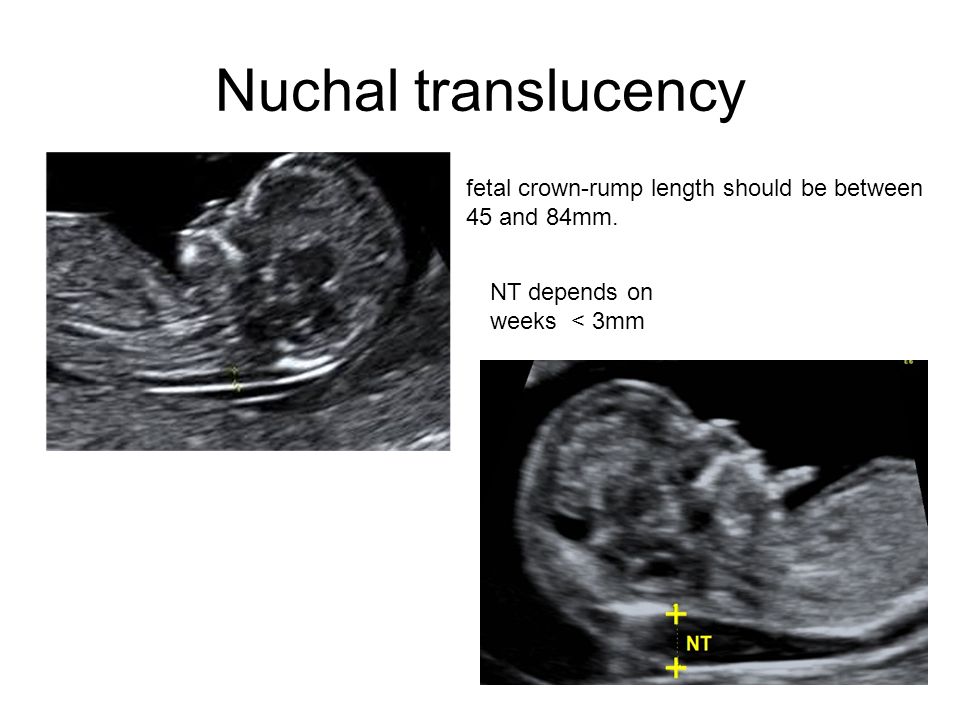 Nuchal translucency fetal crown-rump length should be between 45 and 84mm. 