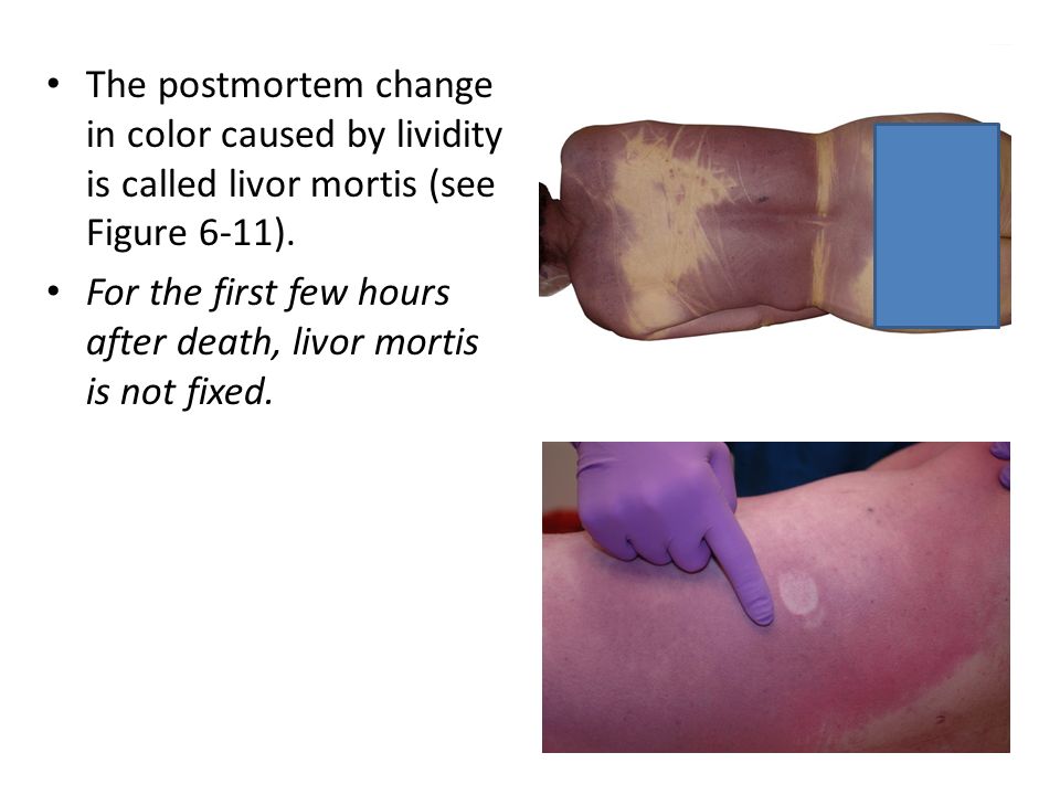 1. Postmortem Lividity and Nail Color - wide 5