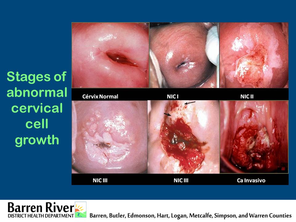 Stages of abnormal cervical cell growth.