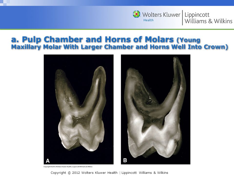 I Internal Pulp Cavity Morphology Related To Endodontic And