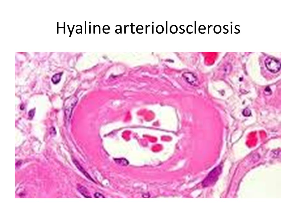 hyaline arteriolosclerosis