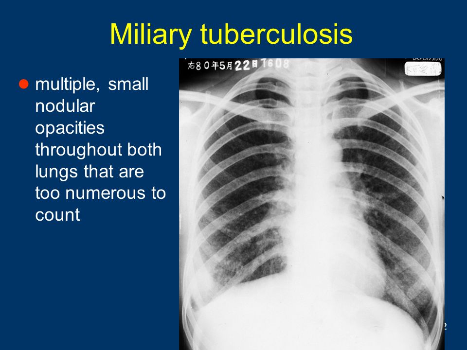Miliary tuberculosis multiple, small nodular opacities throughout both lungs that are too numerous to count.