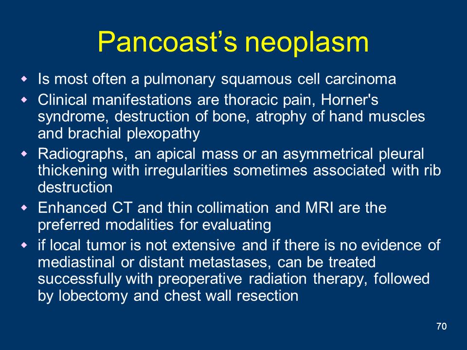 Pancoast’s neoplasm Is most often a pulmonary squamous cell carcinoma