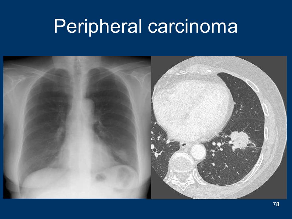 Peripheral carcinoma