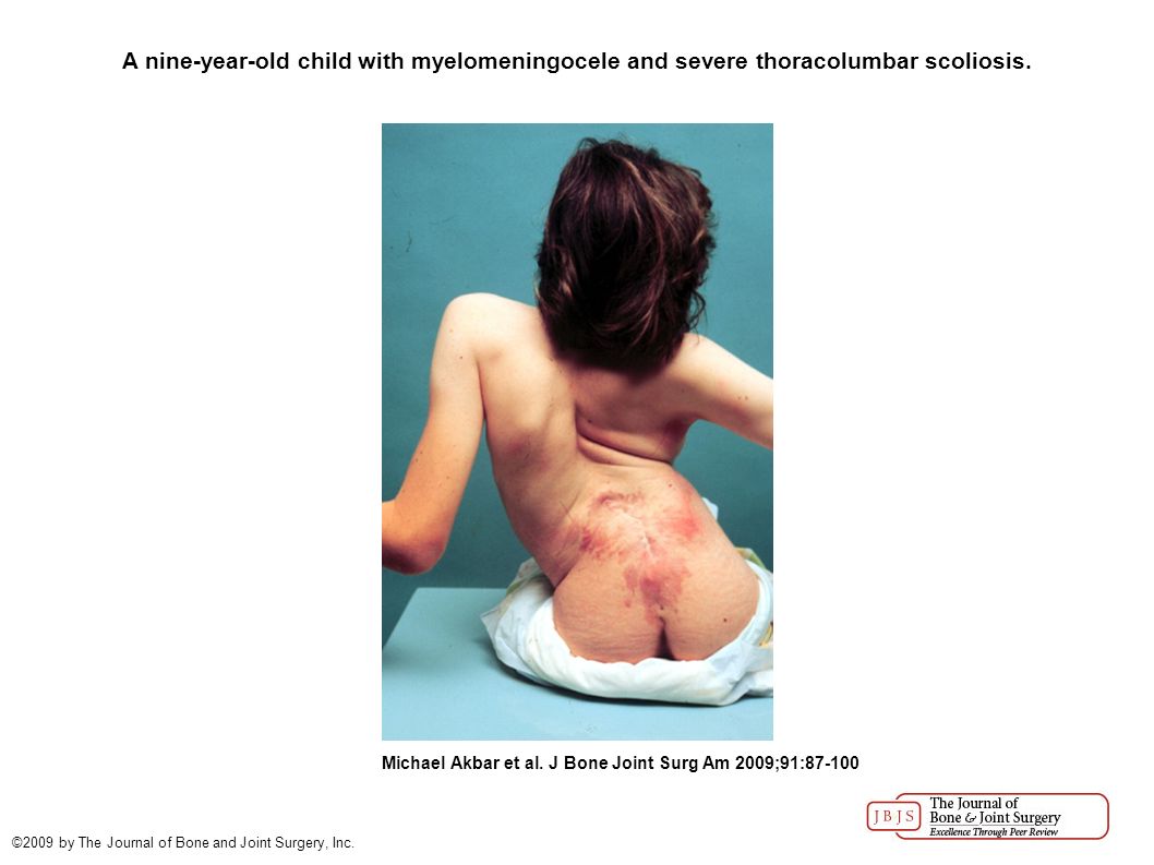 A nine-year-old child with myelomeningocele and severe thoracolumbar scoliosis.