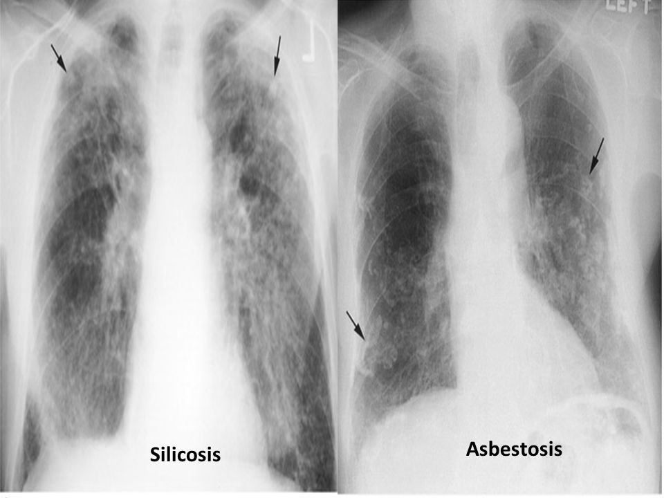 will asbestos cause copd