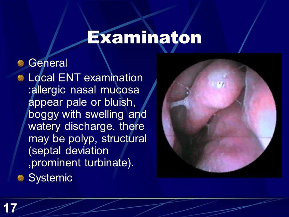 Rhinitis Dr. Mohammad Aloulah. - ppt video online download