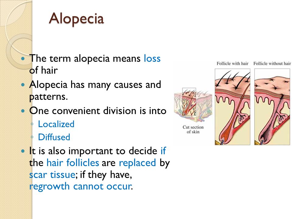 Alopecia The term alopecia means loss of hair