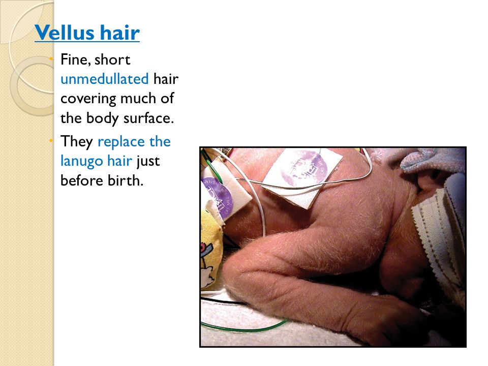 Vellus hair Fine, short unmedullated hair covering much of the body surface.