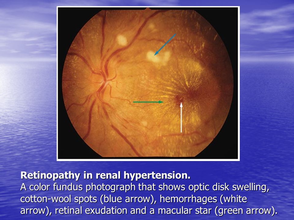 Retinopathy in renal hypertension