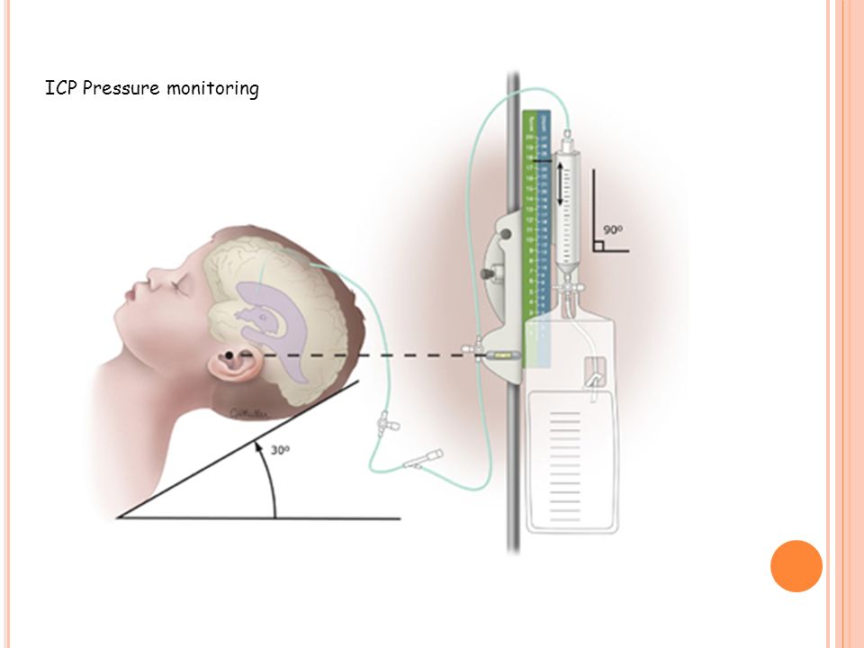 Шунт головного мозга. Вентрикуло перитонеальный шунт. Аппарат для измерения внутричерепного давления. Система наружного вентрикулярного дренажа.