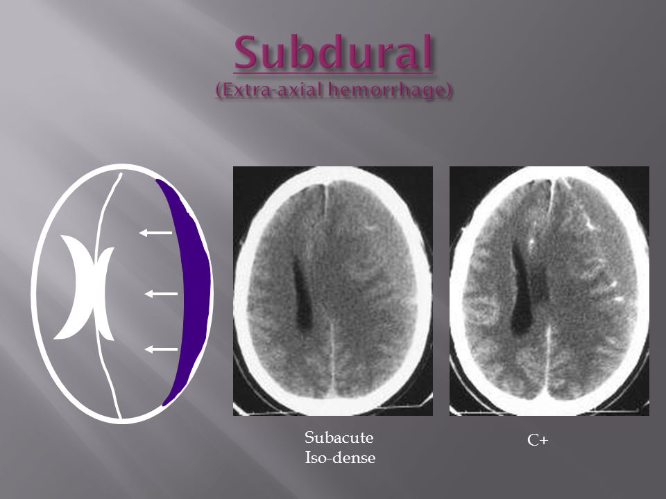 Subdural (Extra-axial hemorrhage)