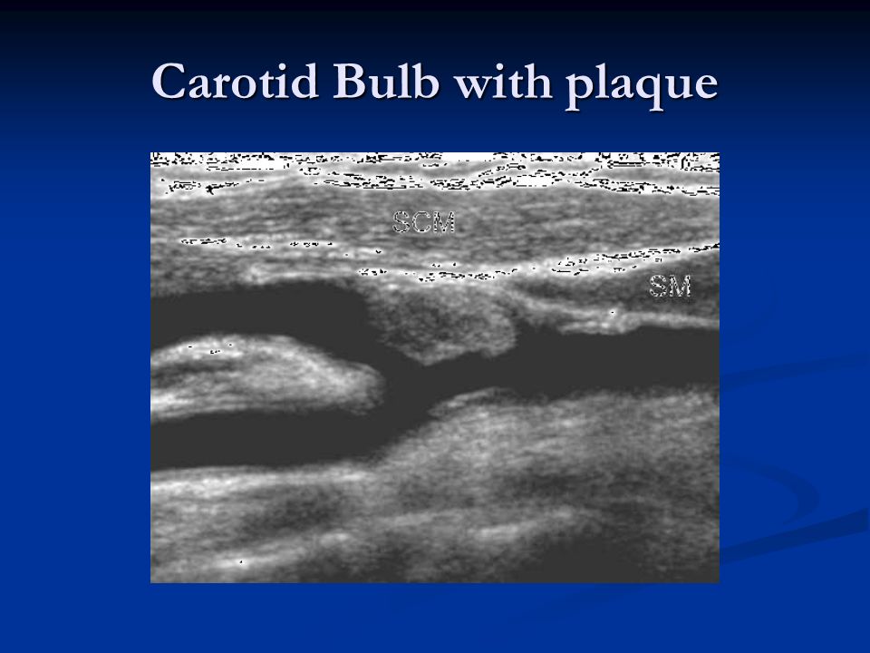 Carotid Bulb with plaque