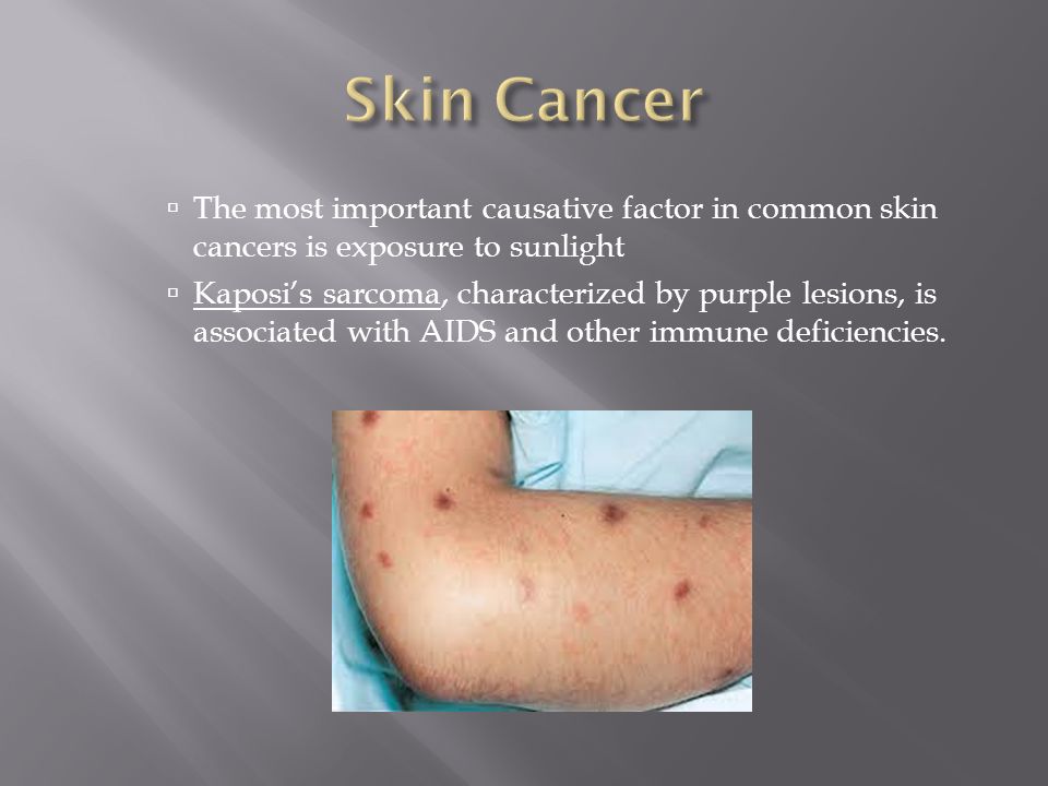 Skin Cancer The most important causative factor in common skin cancers is exposure to sunlight.
