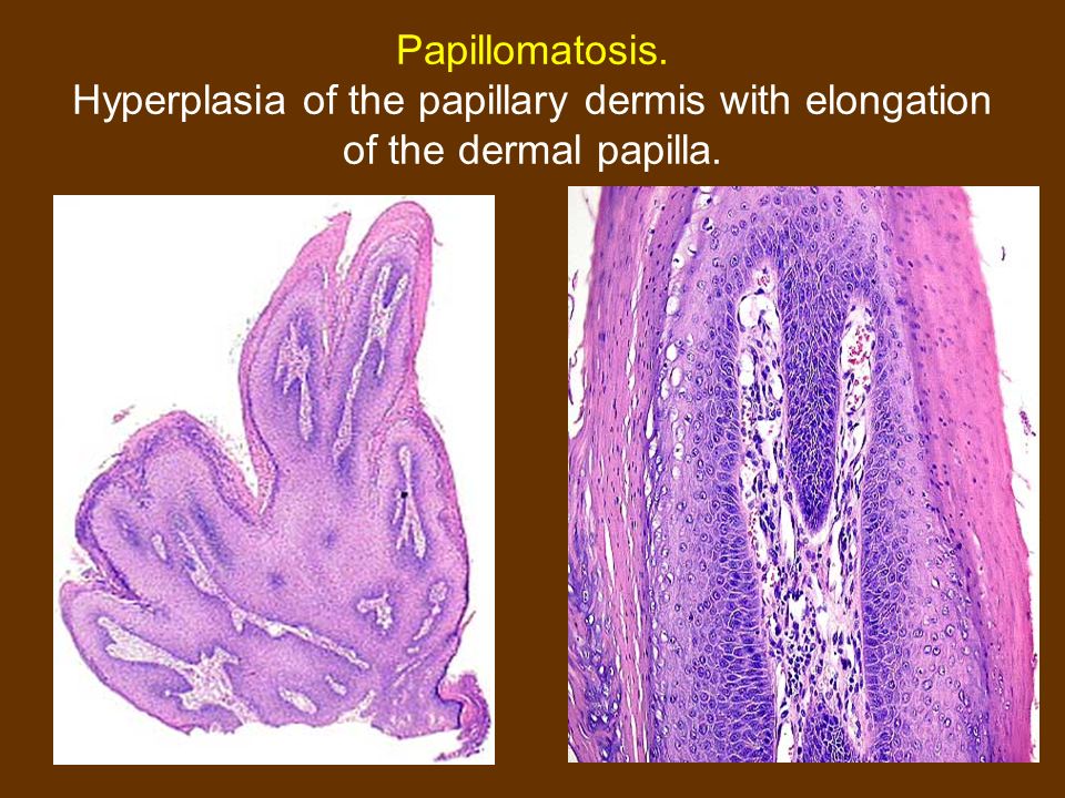 Papillomatosis dermatopathology. Histopathology of confluent and reticulated papillomatosis
