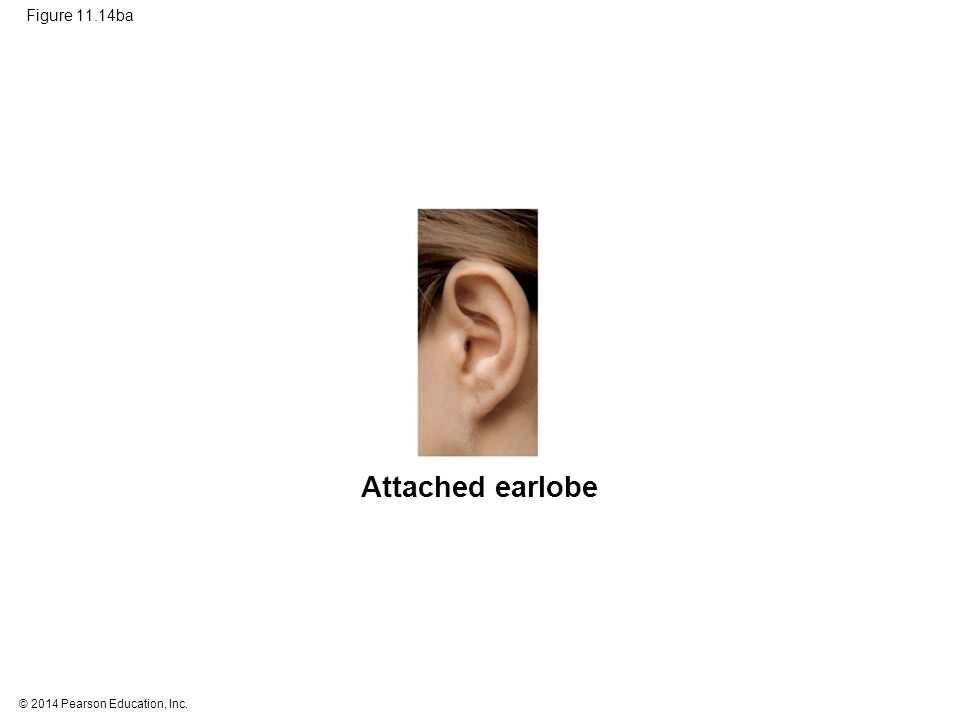 Attached earlobe Figure 11.14ba