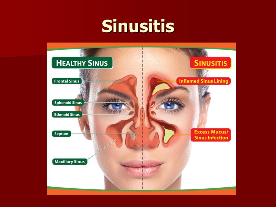 Sinusitis.