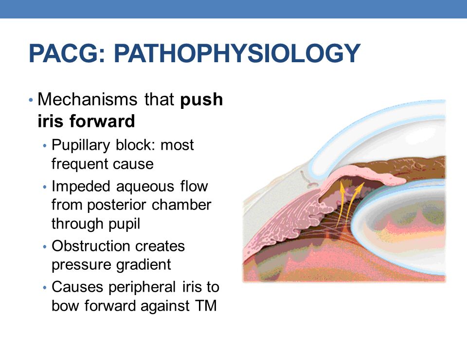 ANGLE-CLOSURE GLAUCOMA - ppt video online download